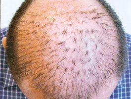 Laser Hair Removal & Treatment in Jaipur | Rejuvenate Clinic